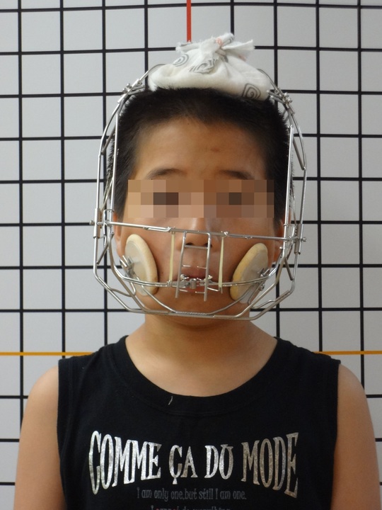ビスケ様 ツインブロック機能療法 顎顔面整形治療における矯正歯科的応用 低料金を目指す矯正歯科へようこそ！